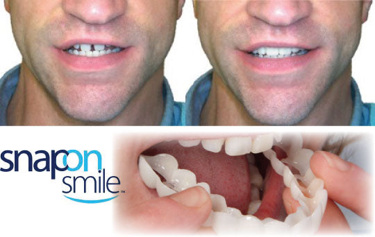 CARRILAS DENTALES- ✨ ¡Transforma Tu Sonrisa al Instante!